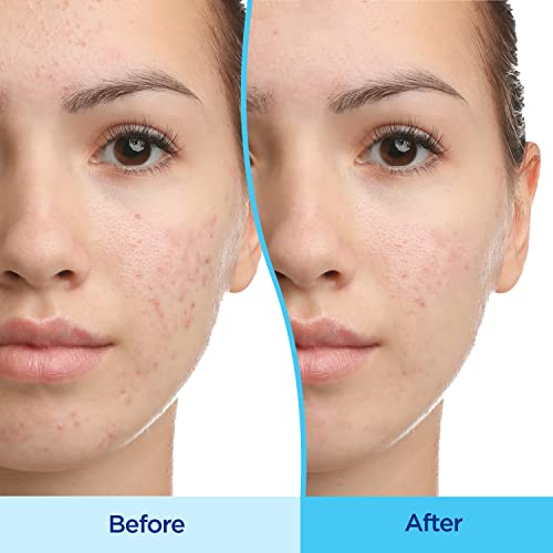 Differin Acne Treatment Gel, 30 Day Supply, Retinoid Treatment for Face with 0.1% Adapalene, Gentle Skin Care for Acne Prone Sensitive Skin, 15g Tube