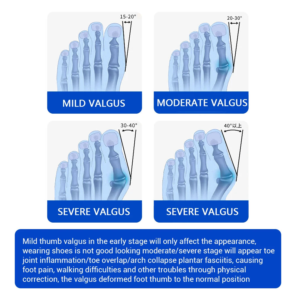 Bunion Corrector Toe Separator Foot Hallux Valgus Braces Orthotics Feet Bone Adjuster Correction Toe Straightener Foot Care Tool